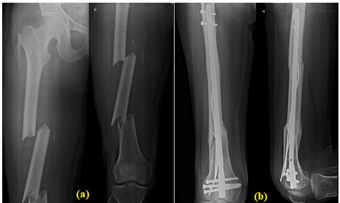 Surgical Treatment of Ipsilateral Multi-Level Femoral Fracture Treated  Using Antegrade Intramedullary Nail